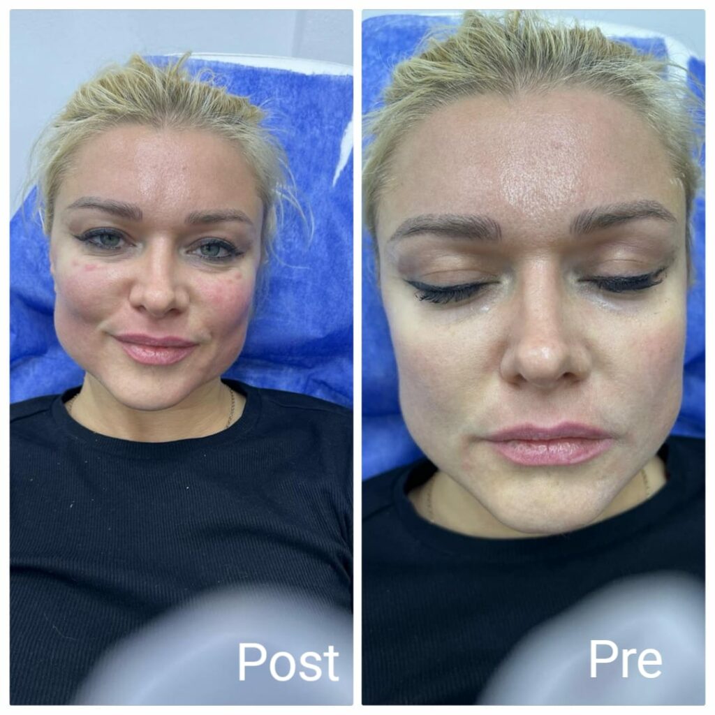 ابرة نضارة و توريد للوجه و الخدود